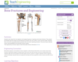 Bone Fractures and Engineering
