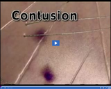 Healthy Skeletal and Muscular Systems: Contusion video clip