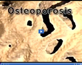 Healthy Skeletal and Muscular Systems: Osteoporosis