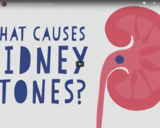 TED Ed - What causes kidney stones? - Arash Shadman