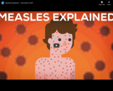 Measles Explained - Vaccinate or Not?