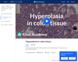 Hyperplasia in Colon Tissue