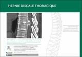 Hernie discale thoracique
