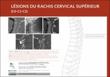 Lésions du rachis cervical supérieur (C0-C1-C2)