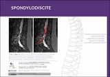 Spondylodiscite
