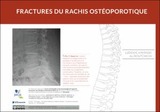 Les fractures du rachis ostéoporotique