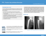 OER-UCLouvain: Prothèse totale de hanche (PTH) : Fixation des prothèses fémorales