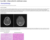 Pathology Case Study: A Man in His 30's with Brain Lesions