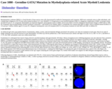 Pathology Case Study: Germline GATA2 Mutation in Myelodysplasia-related Acute Myeloid Leukemia