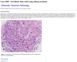 Pathology Case Study: An Elderly Man with Lung Adenocarcinoma