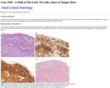 Pathology Case Study: A Male in His Early 70s with a Base of Tongue Mass