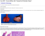 Pathology Case Study: 9-year-old Boy with "Unusual Left Testicular Tumor"