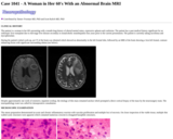 Pathology Case Study: A Woman in Her 60's with an Abnormal Brain MRI an Abnormal Brain MRI