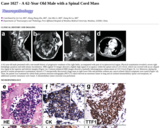 Pathology Case Study: A 62-Year Old Male with a Spinal Cord Mass