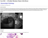 Pathology Case Study: A Peculiar Mucinous Tumor of the Breast