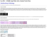 Pathology Case Study: A Middle Aged Male with an Seminal Vesicle Mass