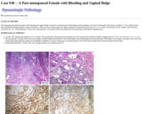 Pathology Case Study: A Post-menopausal Female with  Bleeding and Vaginal Bulge