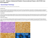 Pathology Case Study: Primary Endometrial Primitive Neuroectodermal Tumors with EWSR Gene Rearrangement