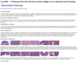 Pathology Case Study: A Woman in her 50s with  Severe Pain in Right Lower Quadrant and Vomiting