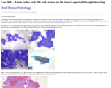 Pathology Case Study: A man in his early 20s with a mass on the lateral aspect of his right lower leg