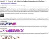 Pathology Case Study: A 75 year-old male with obstructive jaundice and a pancreatic head mass