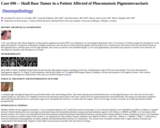 Pathology Case Study: Skull base tumor in a patient affected of phacomatosis pigmentovasclaris