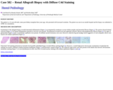 Pathology Case Study: Renal Allograft Biopsy with Diffuse C4d Staining