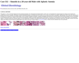 Pathology Case Study: Sinusitis in a 20-year-old Male with Aplastic Anemia