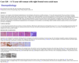 Pathology Case Study: A 72-year old woman with right frontal extra-axial mass