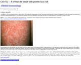 Pathology Case Study: A 10 year old female with pruritic lacy rash