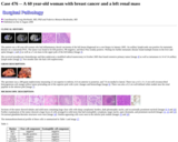 Pathology Case Study: A 60 year-old woman with breast cancer and a left renal mass