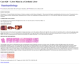 Pathology Case Study: Liver mass in a cirrhotic liver