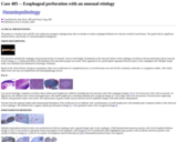 Pathology Case Study: Esophageal perforation with an unusual etiology