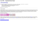 Pathology Case Study: Neonatal female with congenital brain tumor