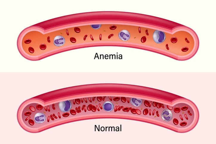 Anemia: A Common Primary Care Condition | OER Commons