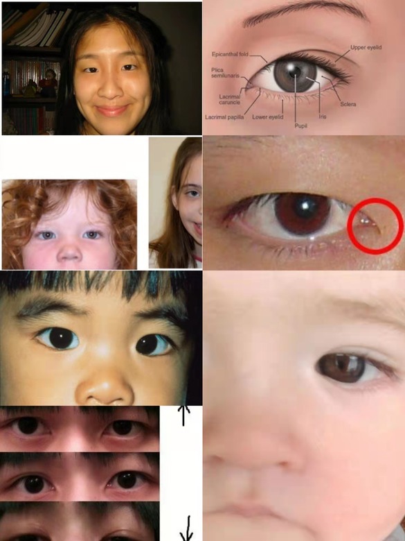 epicanthal folds vs normal