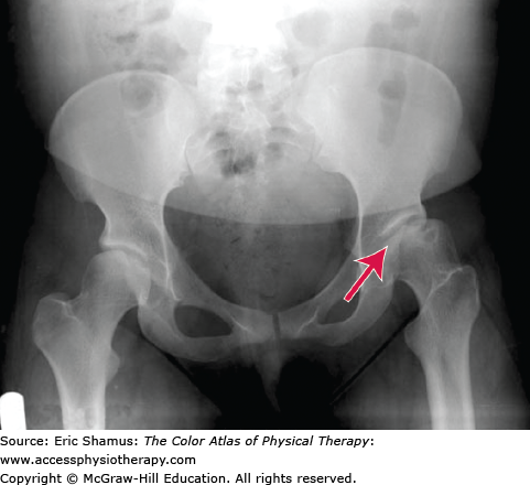 LEGG-CALVÉ-PERTHES DISEASE: A PROBLEM-BASED LEARNING MODULE