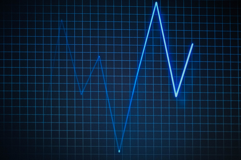 Interpretación prehospitalaria del electrocardiograma en el adulto